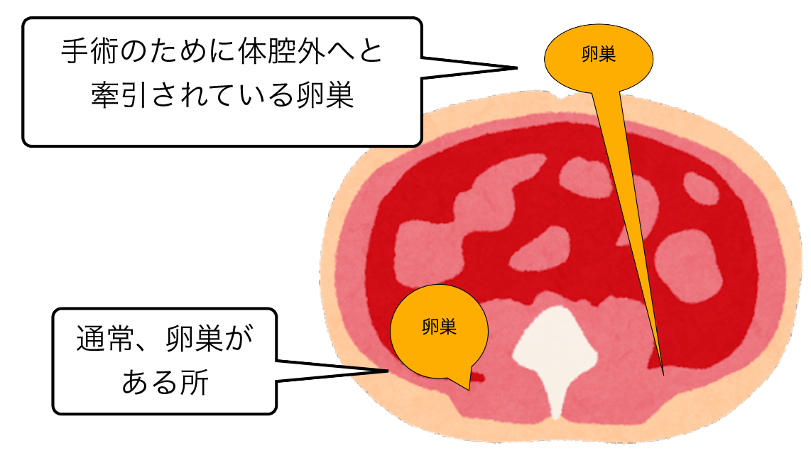 開腹手術のイメージ