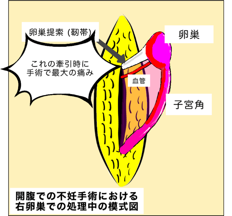 開腹での不妊手術における右卵巣での処理中の模式図